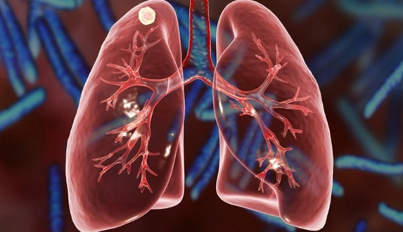 Туберкульоз: факти про захворювання, його симптоми, діагностика й лікування